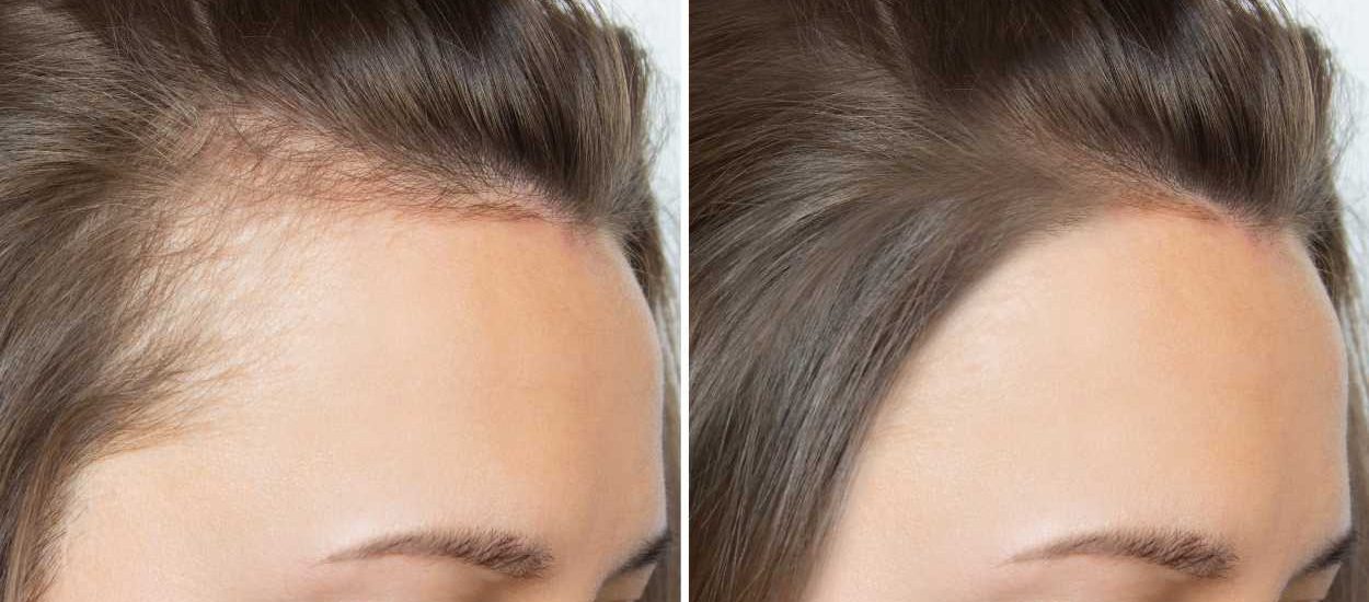 Biberiye suyunu saçta ne kadar bekletmek gerekir? - Kapak Görseli